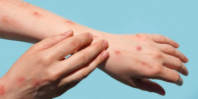 Maymun çiçeği virüsünün ismi değişti