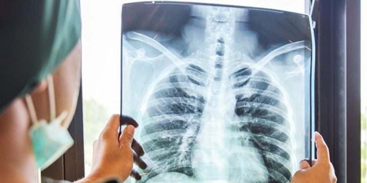 Göğüs Hastalıkları Uzmanı Özkaya: Pandeminin ilk zamanlarındaki akciğer vakaları yeniden gelmeye başladı