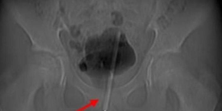 12 yaşındaki çocuğun penisinden, termometre çıkarıldı!