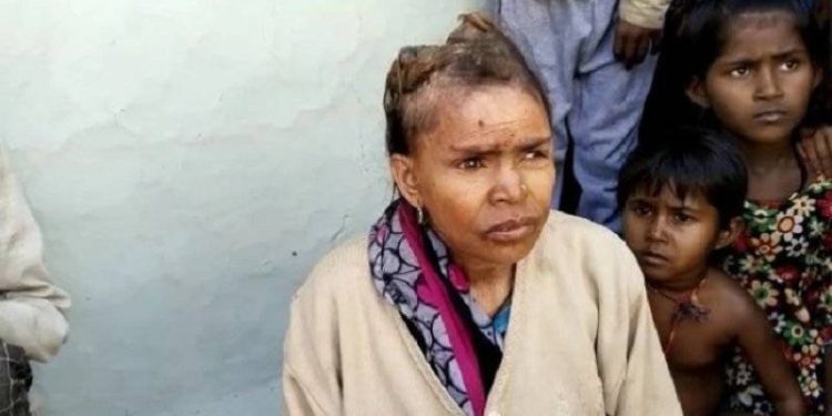 Hindistan'da bir kadının kafasında boynuzlar çıkıyor