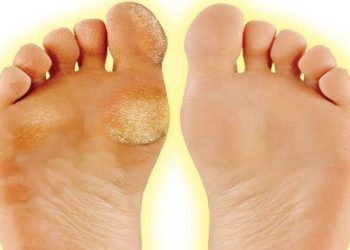 Nasır sorunu olanlar toplanın: İşte ayakta çıkan nasıra kalıcı çözüm