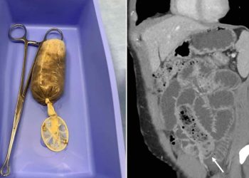 Prezervatife sıkıştırılmış muz yedi, acillik oldu