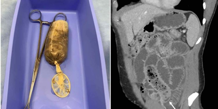 Prezervatife sıkıştırılmış muz yedi, acillik oldu