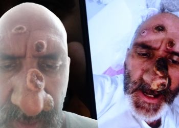 Afrika sineği ısırığıyla hayatı karardı, tanınmayacak hale geldi!