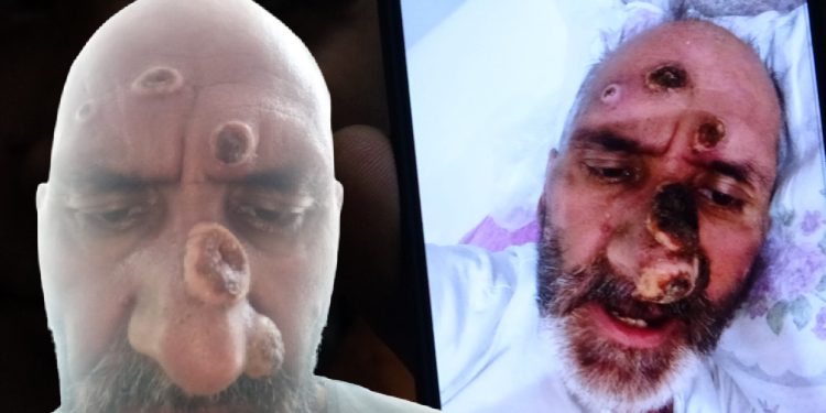 Afrika sineği ısırığıyla hayatı karardı, tanınmayacak hale geldi!