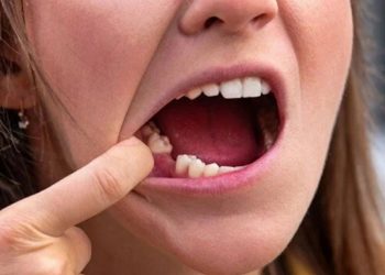 Dişleri nedeniyle işe başladığı gün kovuldu