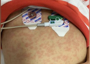 Uzmanı uyardı: Yıllardır görmediğimiz kızamık vakaları yeniden ortaya çıktı