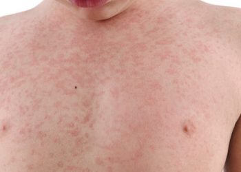 Yemen’de kızamık salgını: 77 çocuk öldü