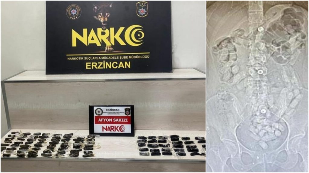 İranlı iki kadının midelerinden 693,3 gram Afyon sakızı çıktı