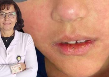 Uzmanlardan İstanbul için kızamık uyarısı: Vaka sayısında artış var