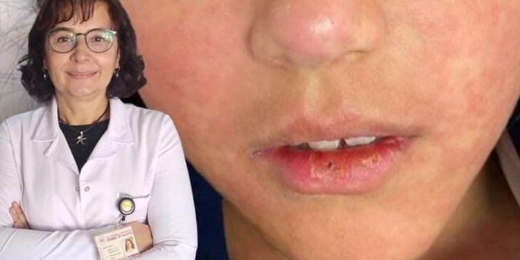 Uzmanlardan İstanbul için kızamık uyarısı: Vaka sayısında artış var