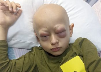 Gözündeki şişlik günlerdir inmedi; Yusuf Kerim, sevenlerinden dua bekliyor