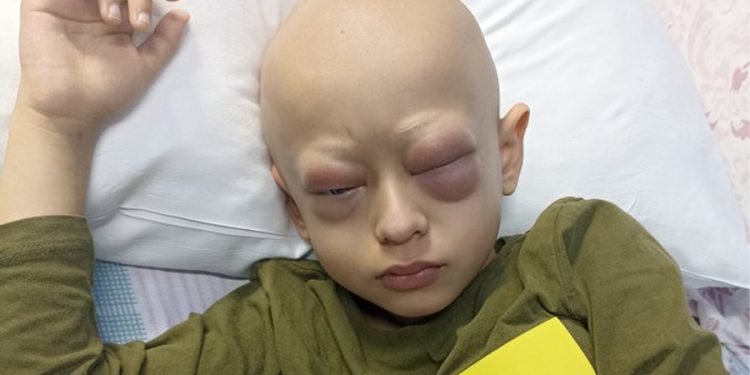 Gözündeki şişlik günlerdir inmedi; Yusuf Kerim, sevenlerinden dua bekliyor