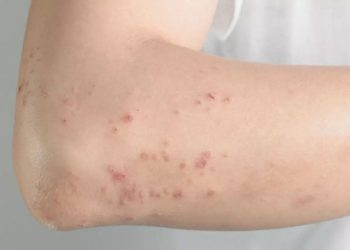 Prof. Dr. Yavuz’dan kızamık uyarısı: Covid'den çok daha bulaşıcı bir salgın hastalıktır