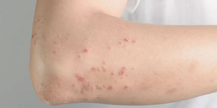 Prof. Dr. Yavuz’dan kızamık uyarısı: Covid'den çok daha bulaşıcı bir salgın hastalıktır