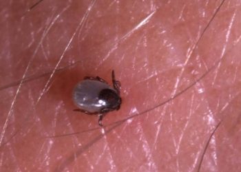 Vücuda yapışan keneyi çıkarmadan acil servise başvurun