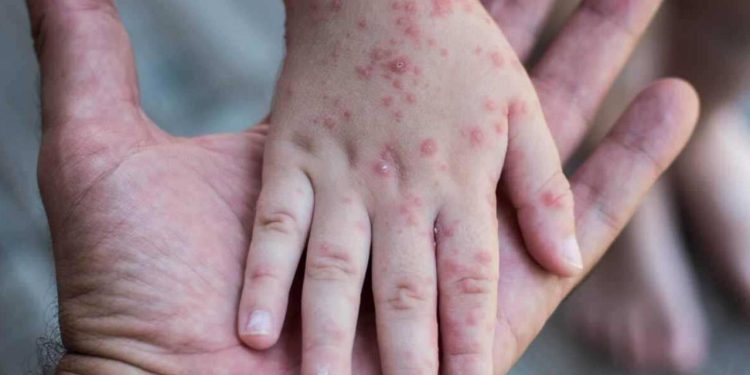 Kızamık vakalarında yüzde 400 artış: 'Koronavirüsten daha ölümcül, tek çare aşı'