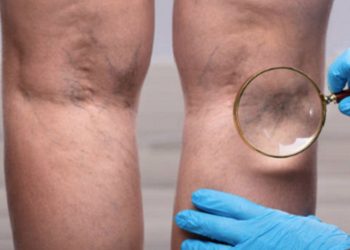 Uzmanı açıkladı: Evden çalışma, erken yaşta varis vakalarını artırıyor