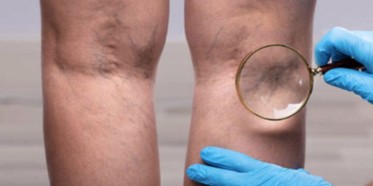 Uzmanı açıkladı: Evden çalışma, erken yaşta varis vakalarını artırıyor