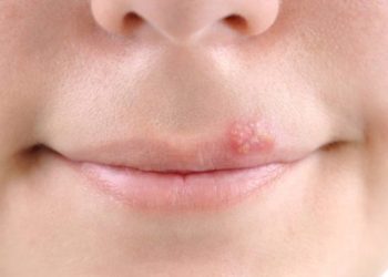 Uzmanı uyardı: Uçuk deyip geçmeyin, bunları yapmaktan kaçının!