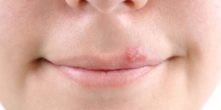 Uzmanı uyardı: Uçuk deyip geçmeyin, bunları yapmaktan kaçının!