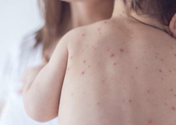 1 yaş altı bebekler risk altında!