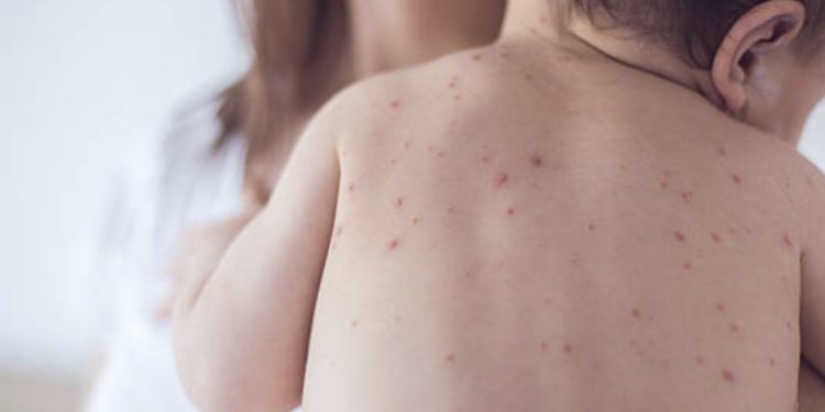 1 yaş altı bebekler risk altında!