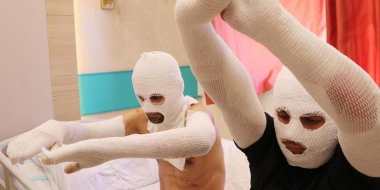 Arabada çakmak doldururken sigara yakınca hastanelik oldular