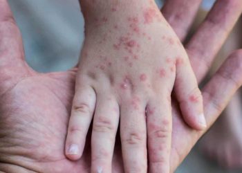 Prof. Saltık'tan 'kızamık' açıklaması: "Yoksulluk nedeniyle komplikasyon gelişebiliyor"