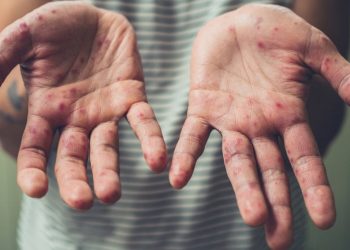 TTB Türkiye'de kızamık verilerini paylaştı, aşı çağrısı yaptı: Salgın, aşısız ya da eksik aşılıların salgını