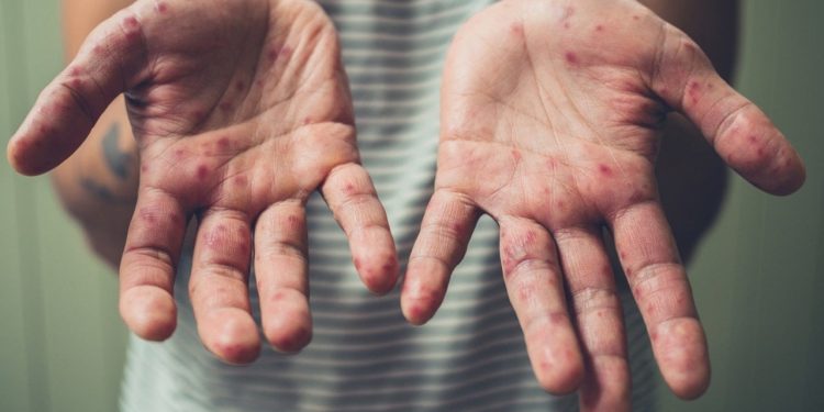 TTB Türkiye'de kızamık verilerini paylaştı, aşı çağrısı yaptı: Salgın, aşısız ya da eksik aşılıların salgını