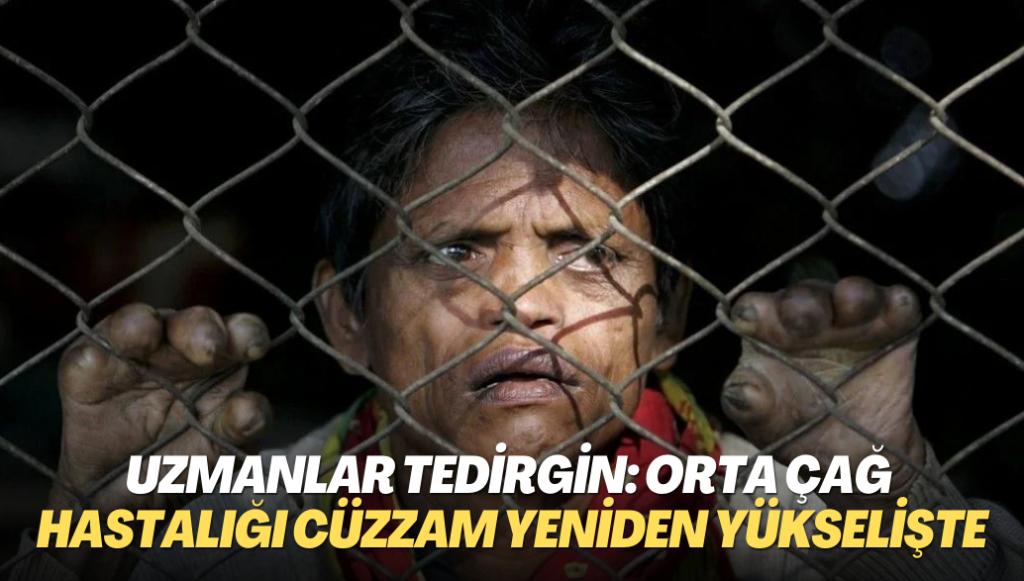 Uzmanlar tedirgin: Orta Çağ hastalığı cüzzam yeniden yükselişte