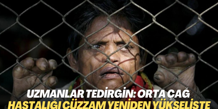 Uzmanlar tedirgin: Orta Çağ hastalığı cüzzam yeniden yükselişte