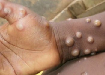 WHO'dan maymun çiçeği raporu: 90 bin vaka, 156 ölüm rapor edildi