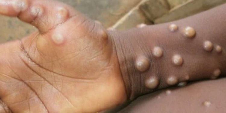 WHO'dan maymun çiçeği raporu: 90 bin vaka, 156 ölüm rapor edildi