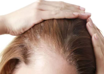 ‘Saçkıran’ belirtilerine dikkat: Bozuk para büyüklüğünde...