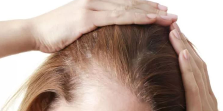 ‘Saçkıran’ belirtilerine dikkat: Bozuk para büyüklüğünde...