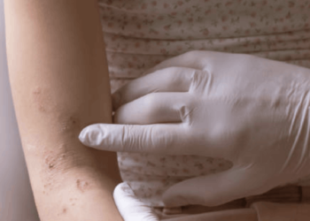 'Egzama çocuklarda daha sık görülüyor'