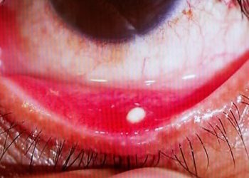 Gözünüzde batma varsa dikkat: Göz taşınız olabilir