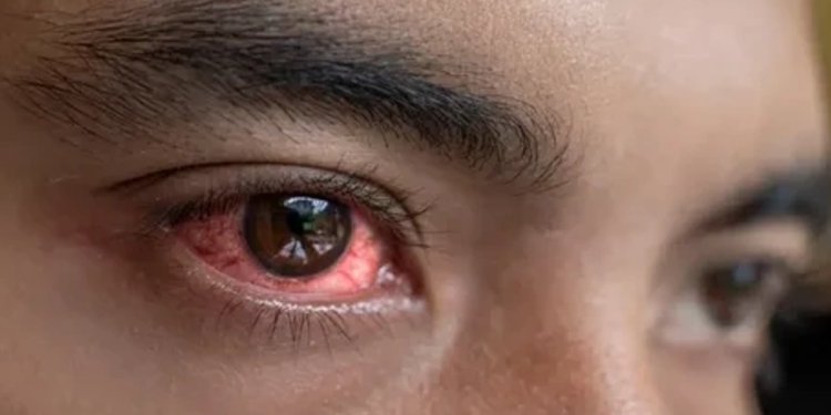 Pakistan’da kırmızı göz salgını