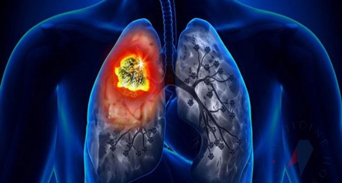 Yeni akciğer kanseri aşısı ölümleri yarı yarıya azaltacak