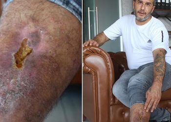 Bacağında unutulan bez parçasıyla 16 yıl yaşadı