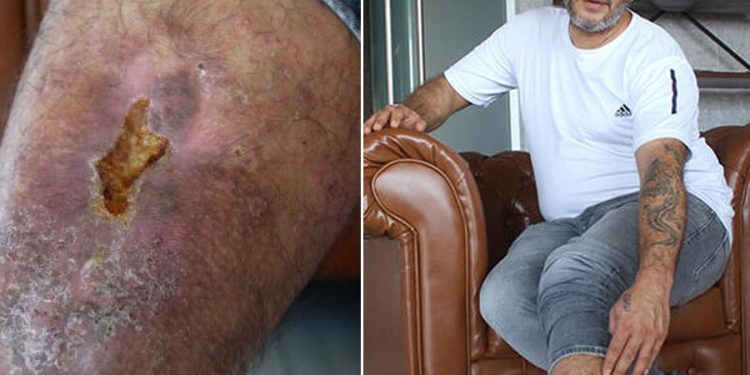 Bacağında unutulan bez parçasıyla 16 yıl yaşadı