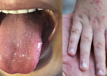 Deprem illeri için salgın uyarısı: El ayak ağız hastalığı nedir, belirtileri nelerdir?