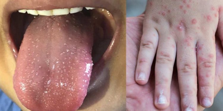 Deprem illeri için salgın uyarısı: El ayak ağız hastalığı nedir, belirtileri nelerdir?