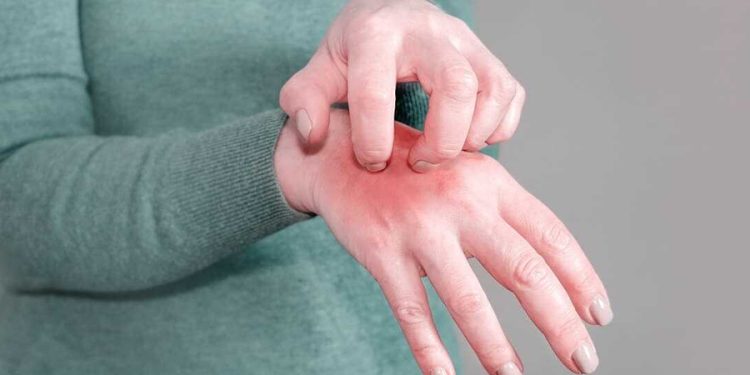 Türkiye’de uyuz vakası son 4 yılda yüzde 40 arttı