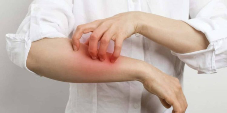 Uyuz vakaları yüzde 30 arttı, bazı kremlere direnç göstermeye başladı