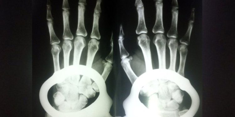 Etlik Şehir Hastanesi Başhekimliği kelepçeli muayeneyi savundu