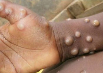 Kongo'da 581 kişi maymun çiçeği virüsünden öldü