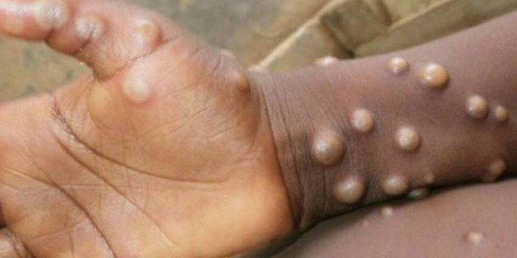 Kongo'da 581 kişi maymun çiçeği virüsünden öldü